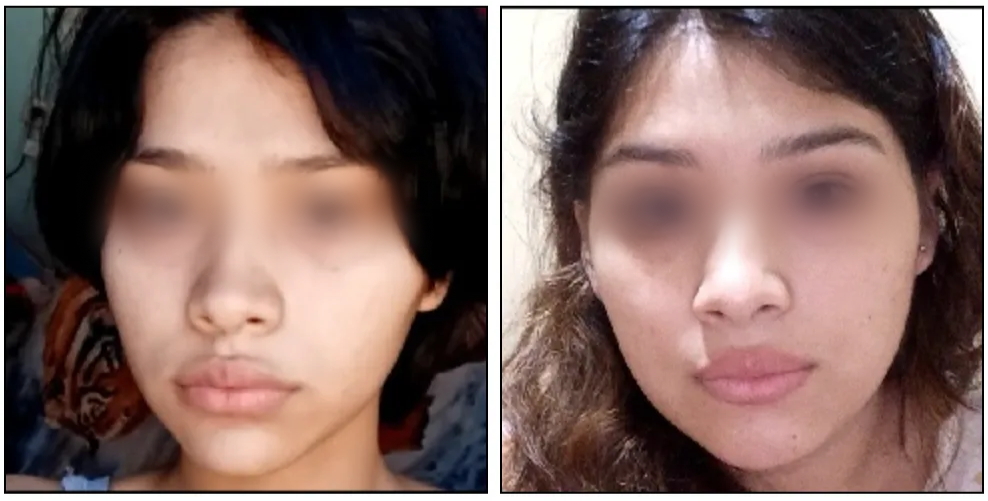 Dos fotos de rostro en primer plano con la región de los ojos difuminada por privacidad.